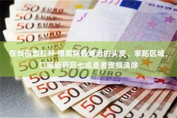 在线股票杠杆 银屑病最难治的头皮、掌跖区域，口服新药后七成患者皮损清除